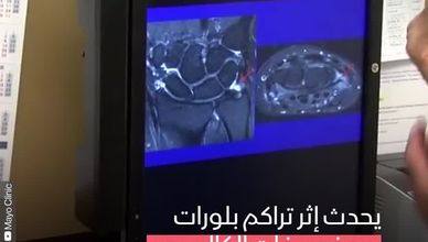 النقرس الكاذب
