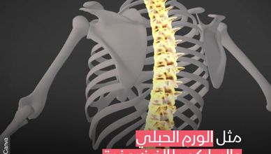 الورم الفقري