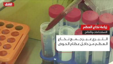 زراعة نخاع العظم.. الاستخدامات والنتائج