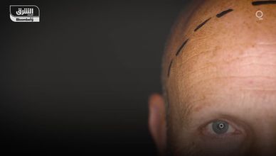 مجال زراعة الشعر يلقى رواجاُ كبيراً في تركيا