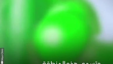 سرطان المعدة