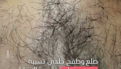 مرض سعفة الرأس.. هل هو معدٍ؟!