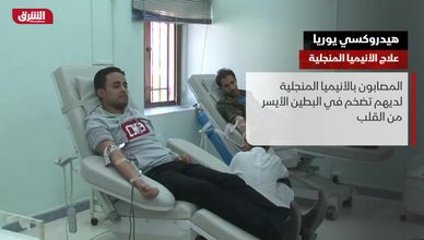 هيدروكسي يوريا.. علاج الأنيميا المنجلية