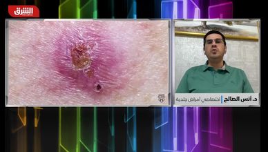 طفح الصيف الجلدي.. بين تغير المناخ وتفاقم العدوى الفطرية