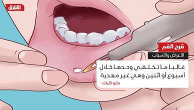 قرح الفم.. الأعراض والأسباب