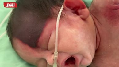 غزة.. ارتفاع عدد المواليد الذين يعانون من تشوهات خلقية