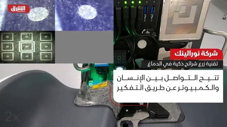 شركة نورالينك.. تقنية زرع شرائح ذكية في الدماغ