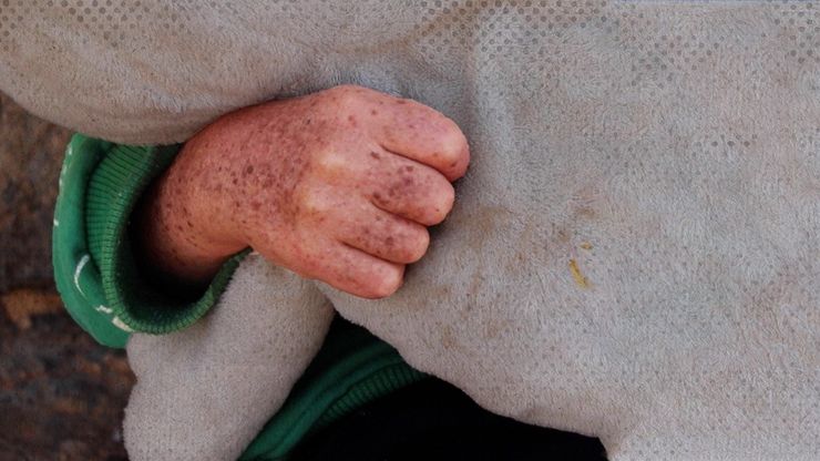 هل تنصف الجزائر مرضى "أطفال القمر"؟