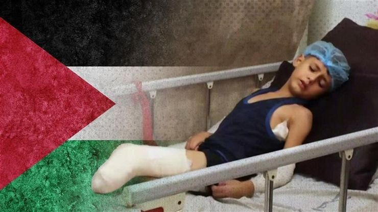 غزة.. عاصمة مبتوري الأطراف في العالم